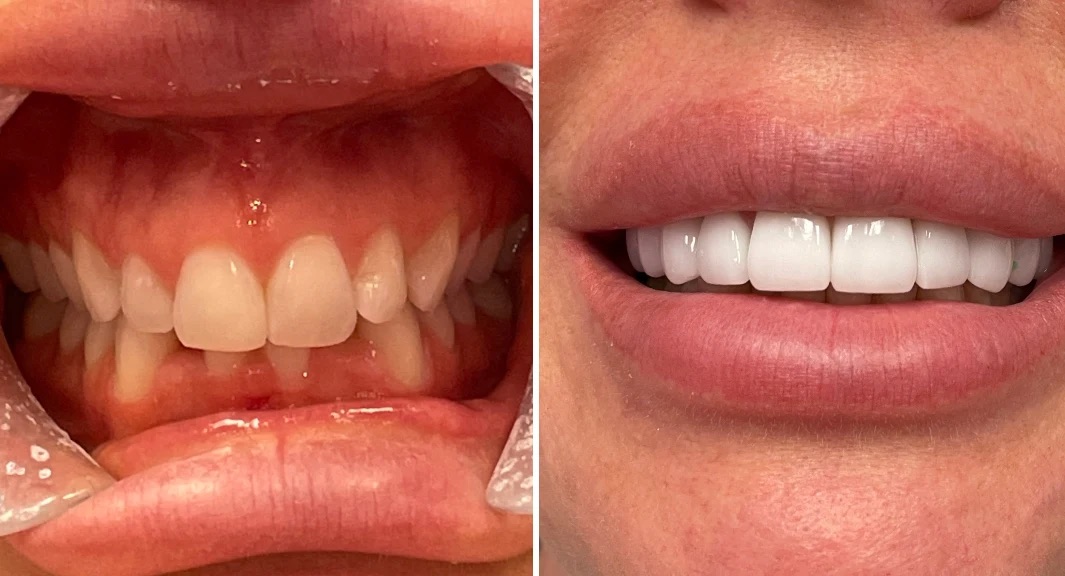 Dental before-and-after case 1 &mdash; Glisten Dental Gilbert