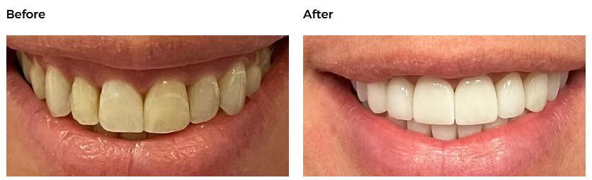Dental before-and-after case 2 &mdash; Glisten Dental Gilbert