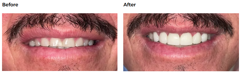 Dental before-and-after case 3 &mdash; Glisten Dental Gilbert