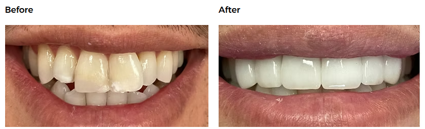 Dental before-and-after case 4 &mdash; Glisten Dental Gilbert