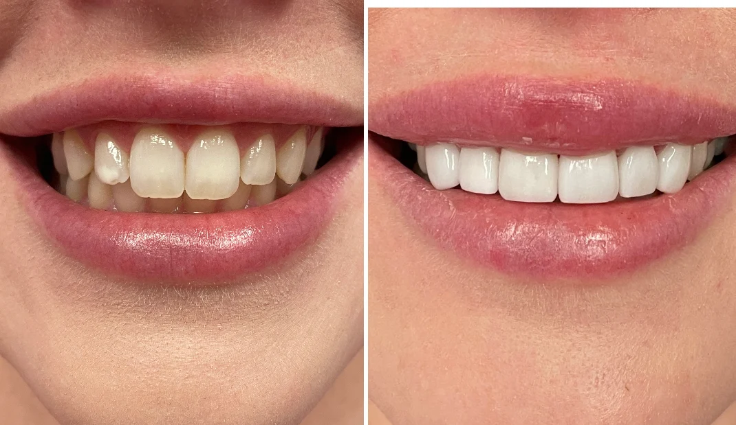 Dental before-and-after case 5 &mdash; Glisten Dental Gilbert