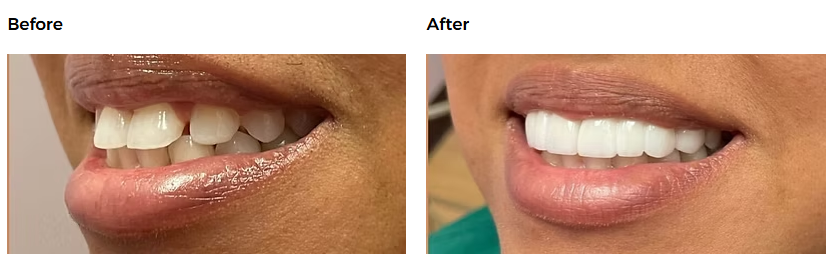 Dental before-and-after case 6 &mdash; Glisten Dental Gilbert