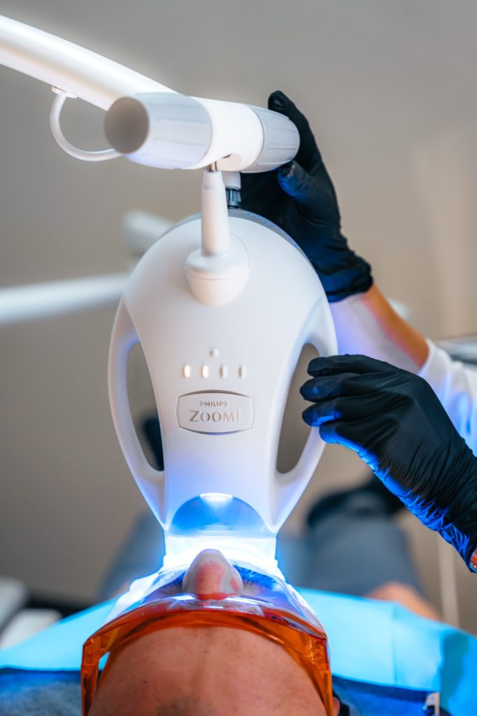 Philips Zoom! teeth whitening treatment in progress at Glisten Dental