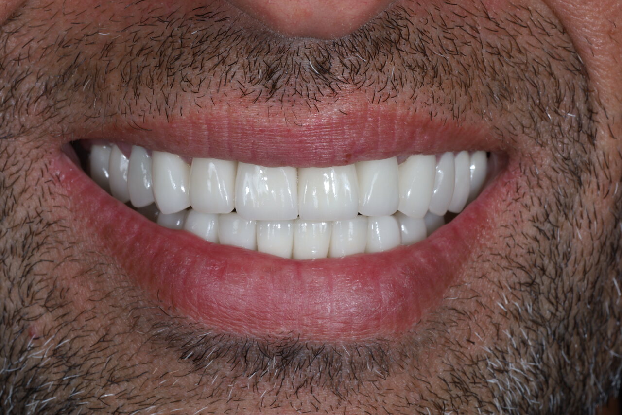 After smile transformation at Glisten Dental Gilbert