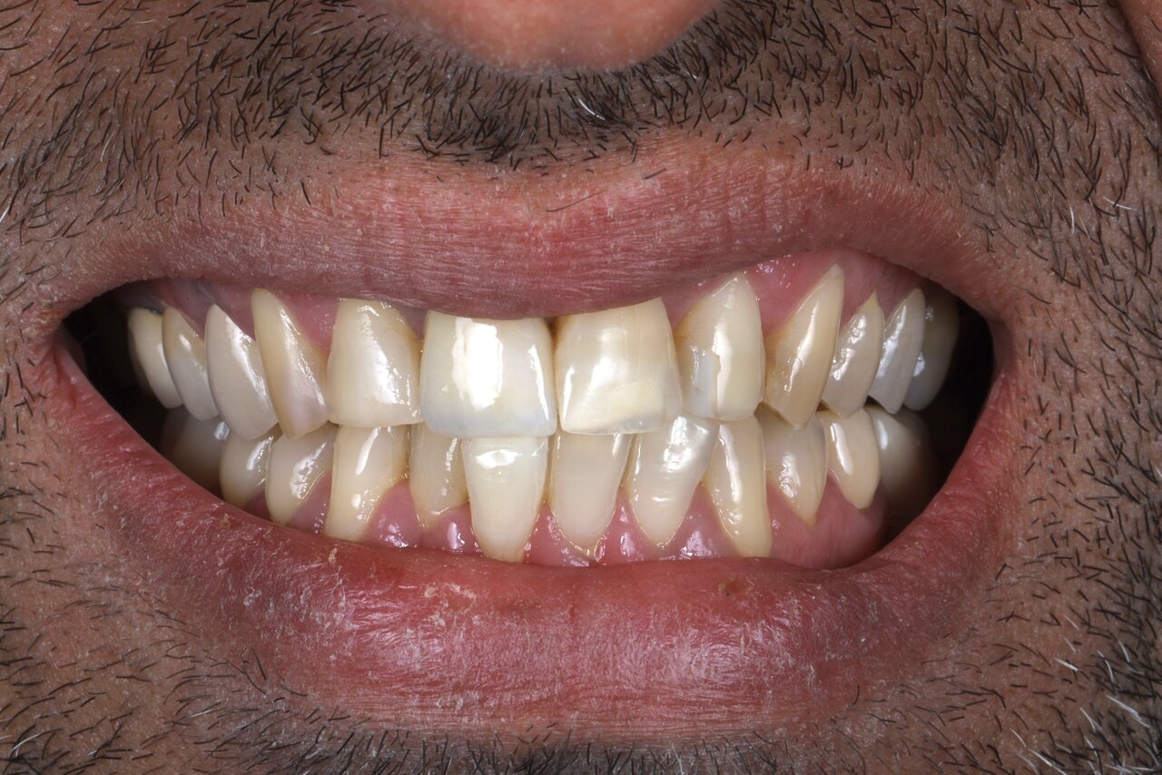 Before smile transformation at Glisten Dental Gilbert