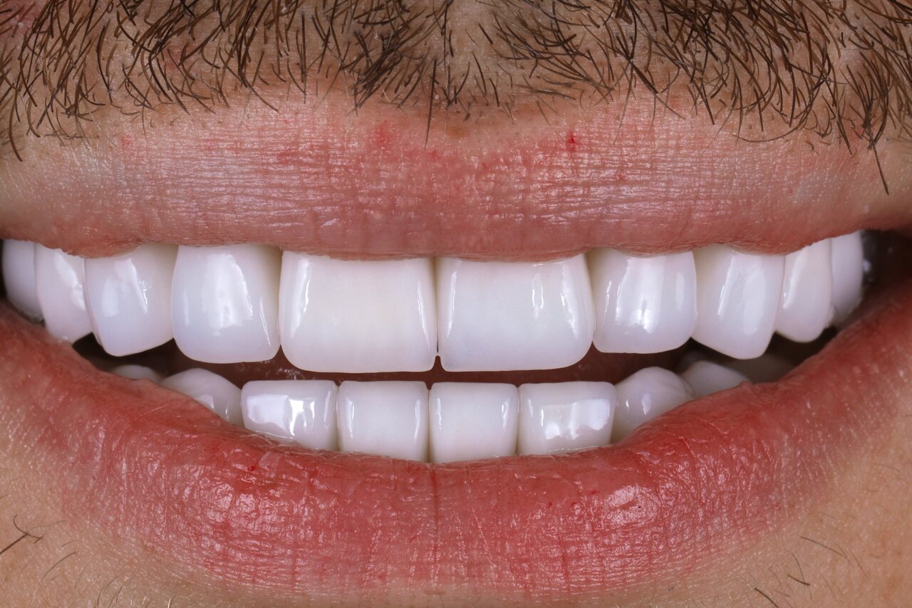 After smile transformation at Glisten Dental Gilbert