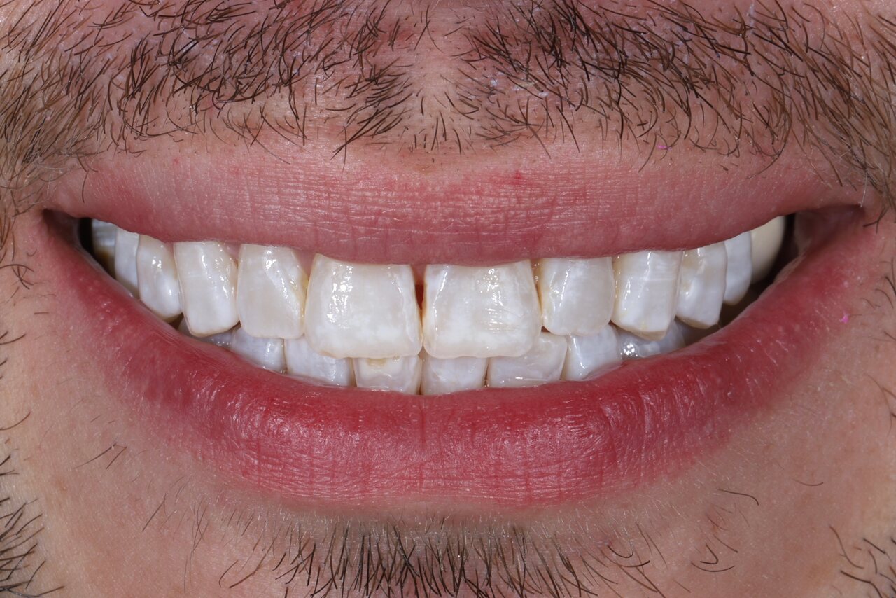 Before smile transformation at Glisten Dental Gilbert