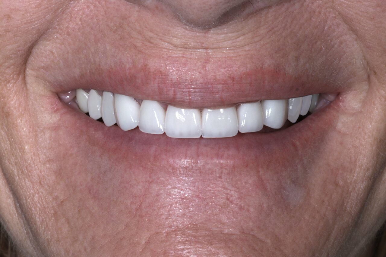 After smile transformation at Glisten Dental Gilbert