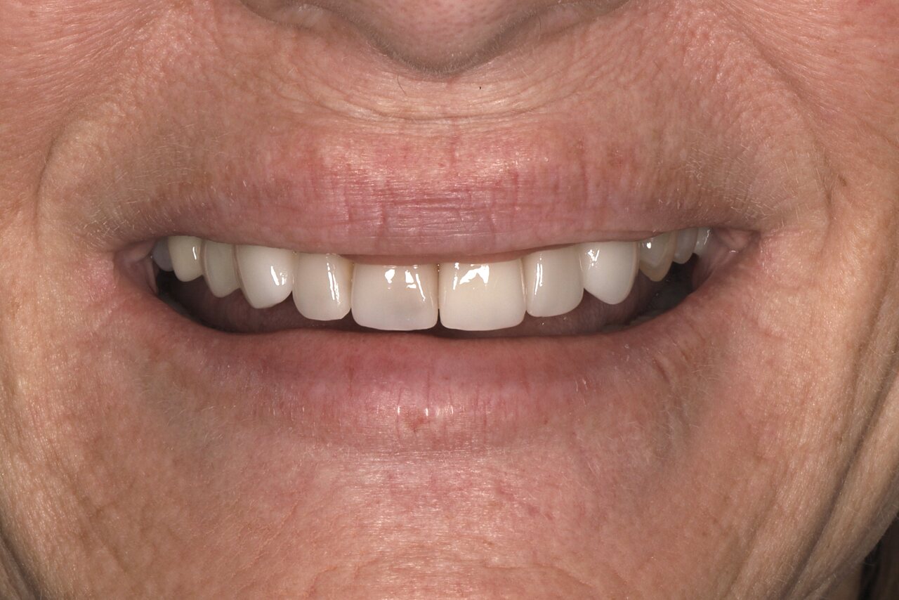 Before smile transformation at Glisten Dental Gilbert