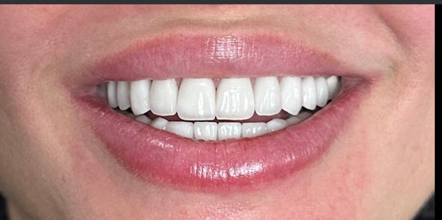 A cosmetic veneer smile result by Dr. Dawood at Glisten Dental Gilbert