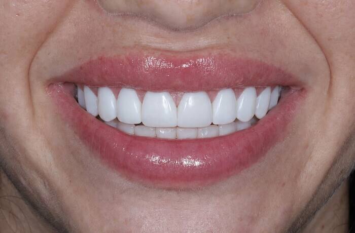 Cosmetic bonding after, Glisten Dental Gilbert