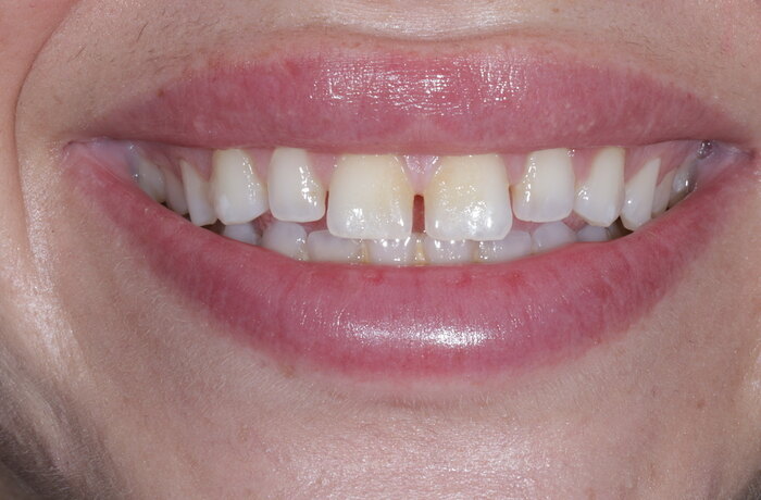 Cosmetic bonding before, Glisten Dental Gilbert