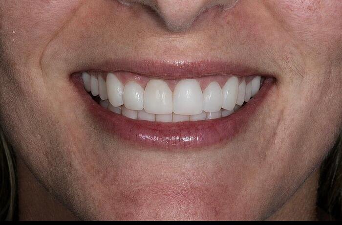 Cosmetic bonding after, Glisten Dental Gilbert