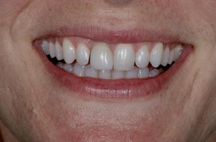 Cosmetic bonding before, Glisten Dental Gilbert