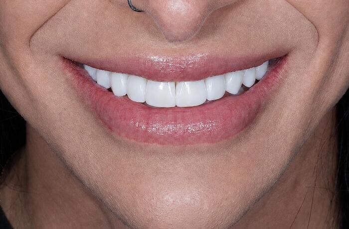 Cosmetic bonding after, Glisten Dental Gilbert