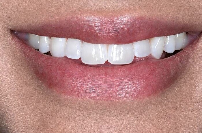 Cosmetic bonding before, Glisten Dental Gilbert