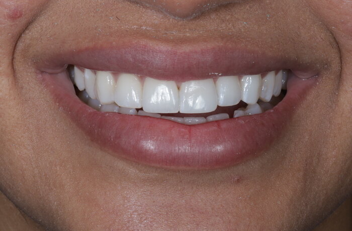 Cosmetic bonding after, Glisten Dental Gilbert