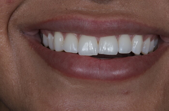 Cosmetic bonding before, Glisten Dental Gilbert